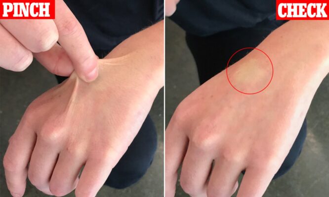 dehydration the pinch test