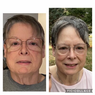 heal parkinson's before and after 1 month of fascial maneuvers